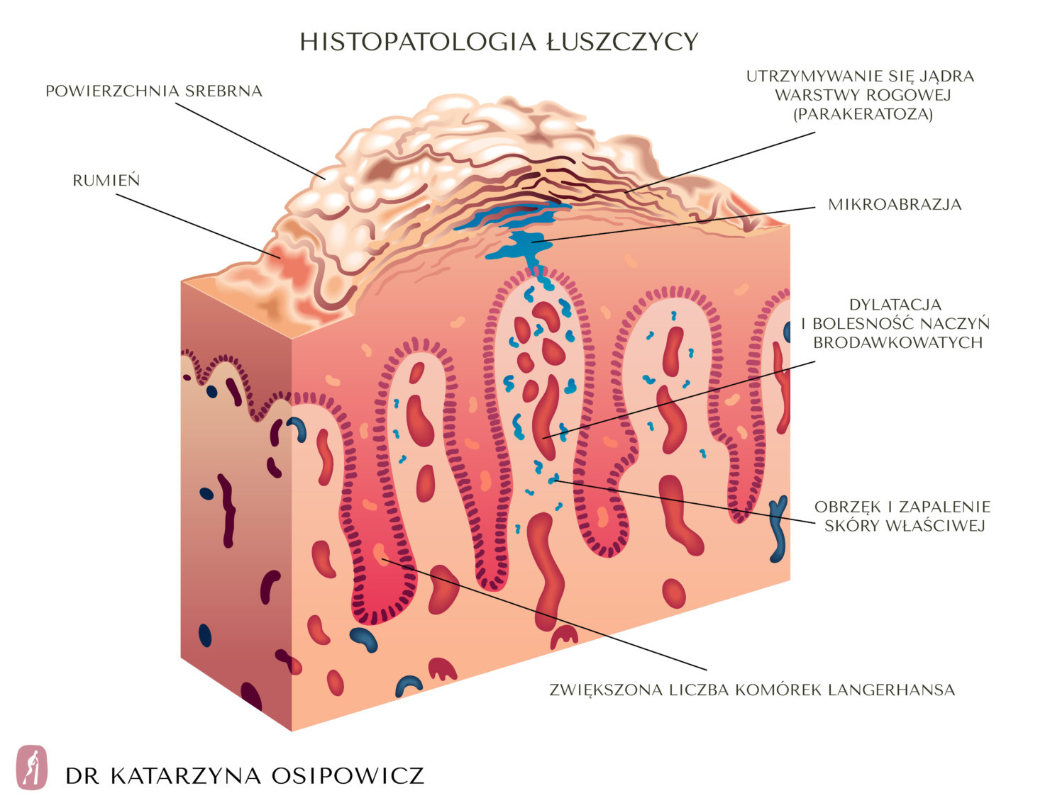 Łuszczyca Objawy I Leczenie Choroby Skóry 4983