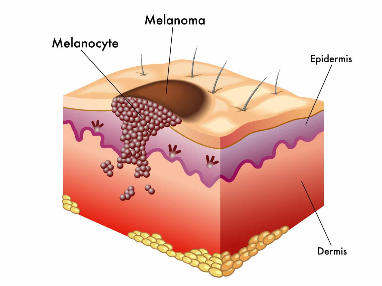 melanoma schemat czerniaka