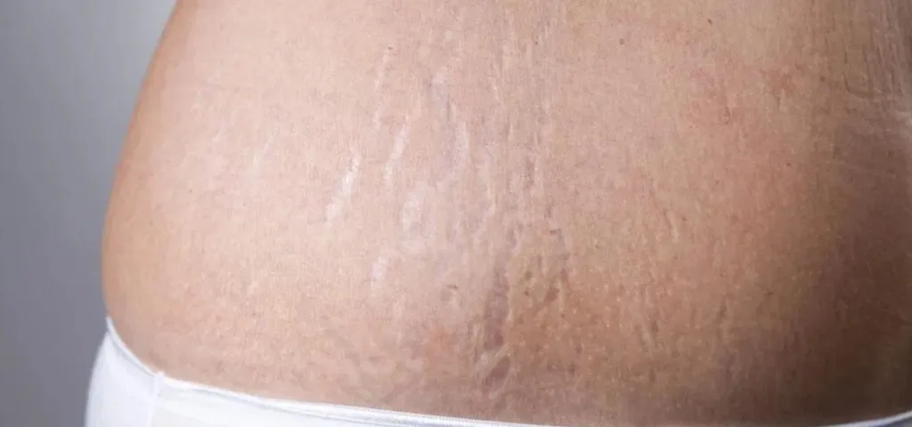 Dermapen na rozstępy