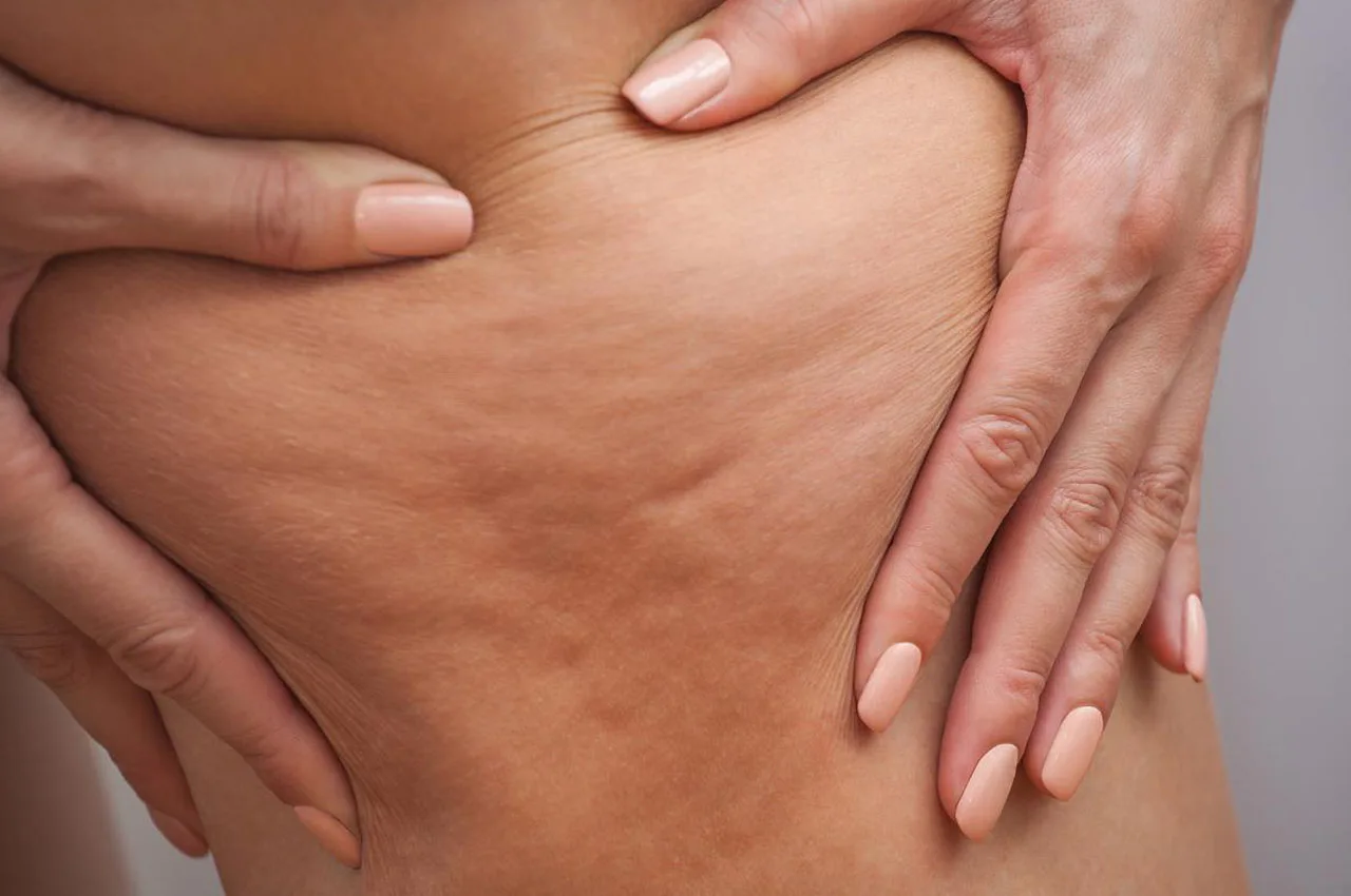 Endermologia na cellulit