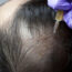 Leczenie łysienia fibryną bogatopłytkową