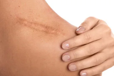 Przebudowa blizn pourazowych Dermapenem
