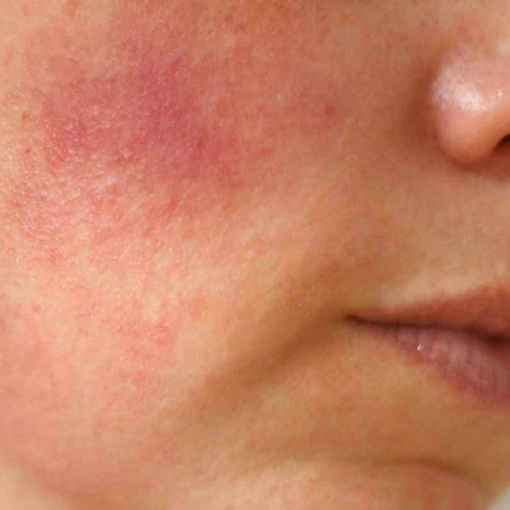 Jak pozbyć się zaczerwienienia na twarzy? | Dr Osipowicz