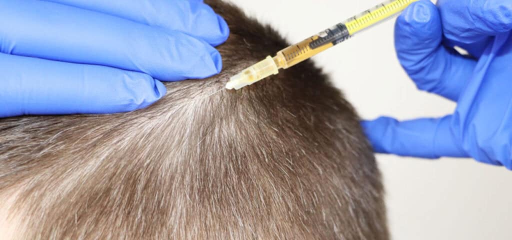 Mezoterapia skóry głowy - podanie preparatu igłą, punkt po punkcie