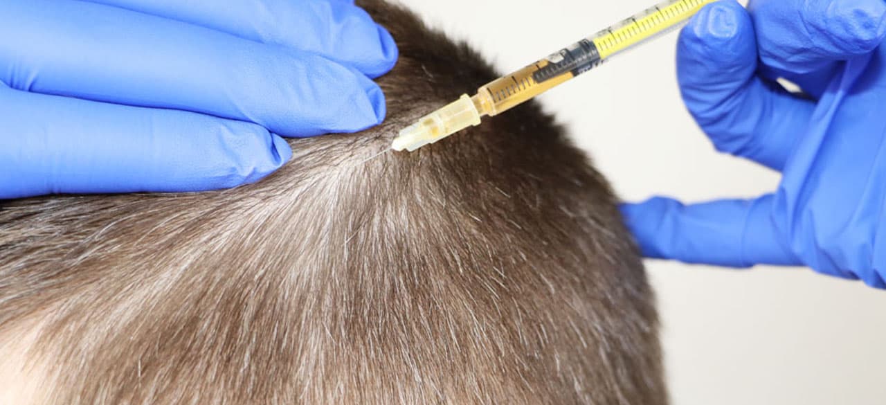 Mezoterapia skóry głowy – Mezoterapia włosów