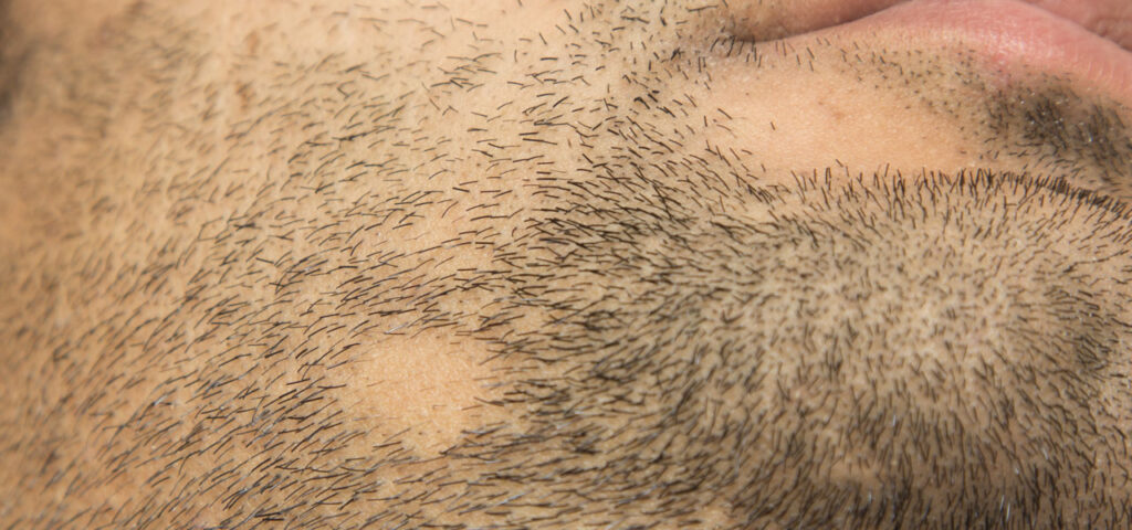 Łysienie plackowate na brodzie