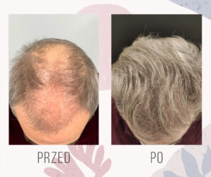 Efekt przeszczepu włosów metodą FUE (3000 graftów)
