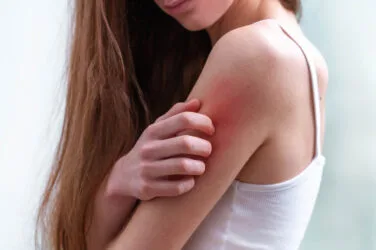Zmiany łuszczycowe na skórze - leczenie dermatologiczne w OK CLINIC Warszawa