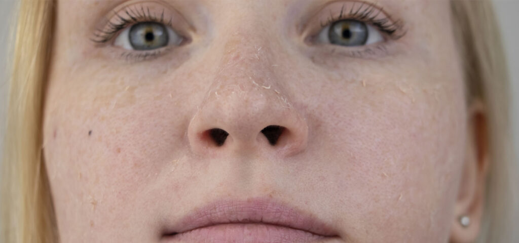 sucha skóra na twarzy