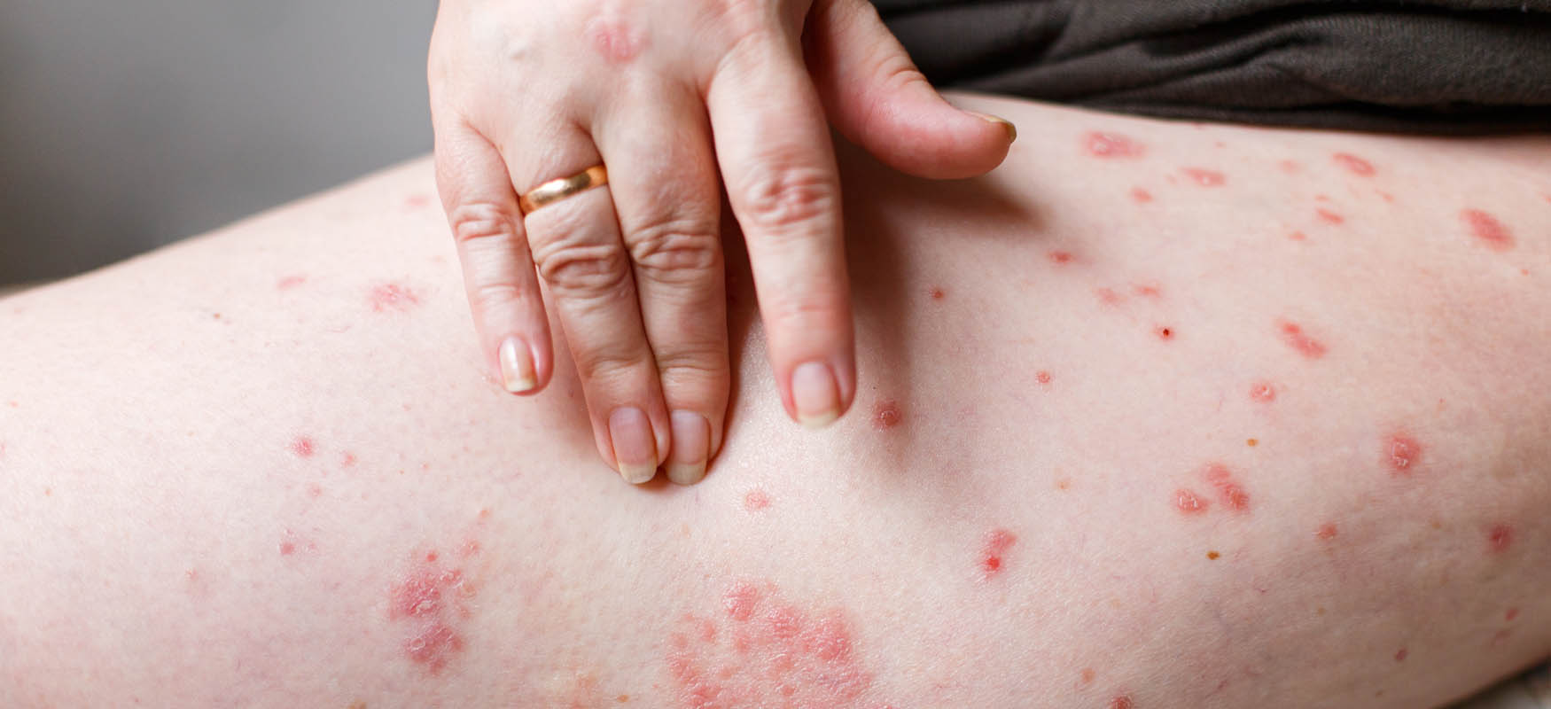 Choroby skóry – przewodnik po najczęstszych schorzeniach dermatologicznych