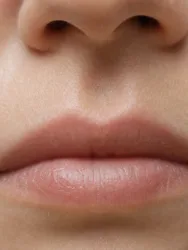 Makro okolicy rynienki nosowo-wargowej i górnej wargi obrazujące obszar zabiegu lip flip