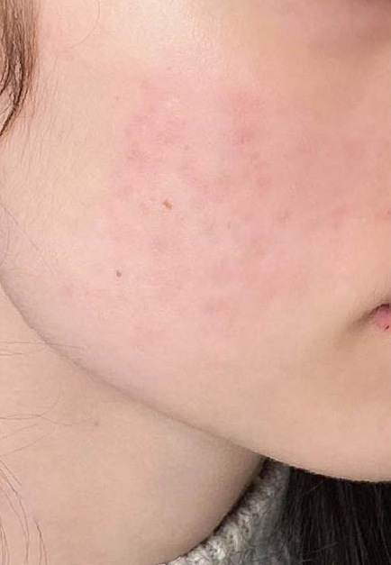 Skóra policzka po zabiegach Dermapen