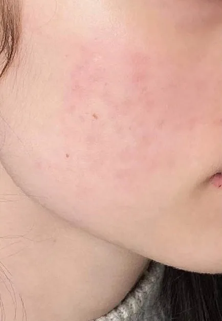 Skóra policzka po zabiegach Dermapen
