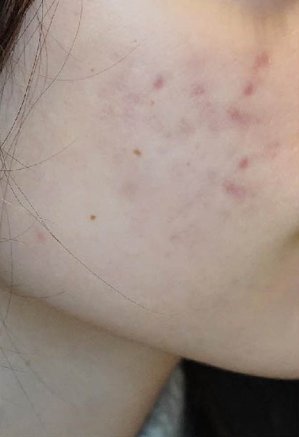 Skóra policzka przed zabiegami Dermapen
