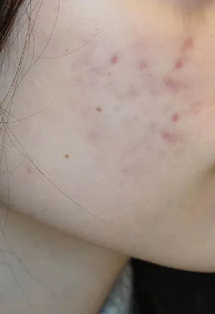 Skóra policzka przed zabiegami Dermapen