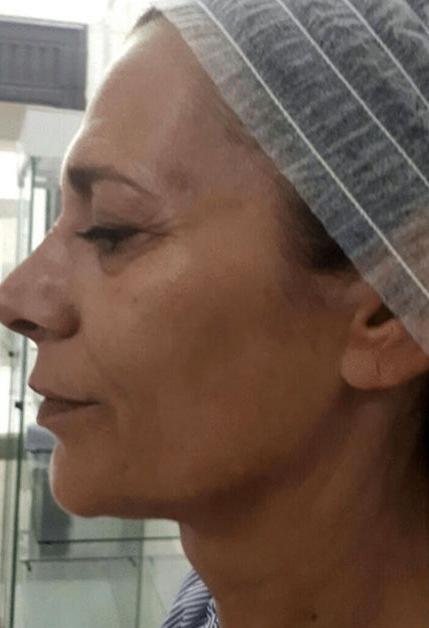 Skóra twarzy przed peelingiem PQ Age