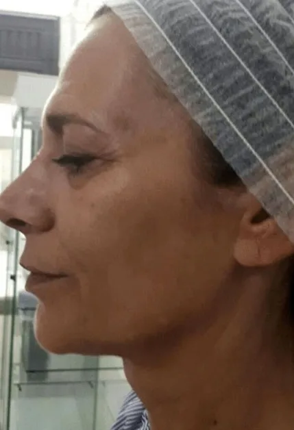 Skóra twarzy przed peelingiem PQ Age