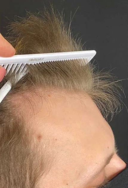 Zakola przed przeszczepem 2123 graftów metodą FUE