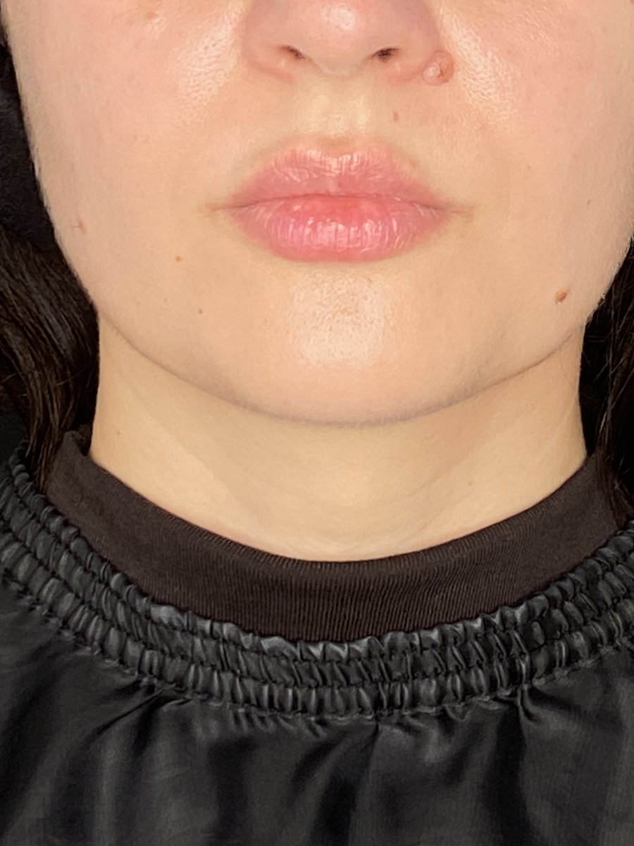 Usta po zabiegu modelowania