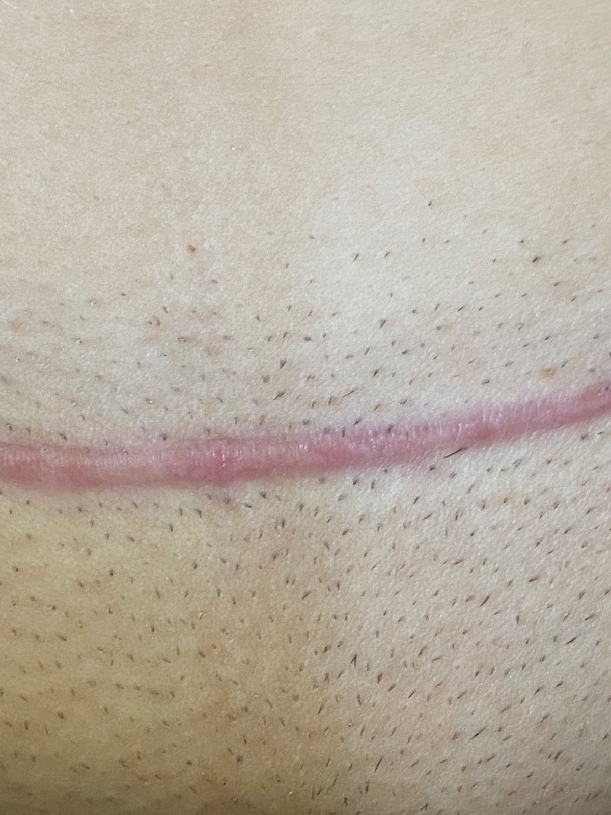 Blizna w okolicy pachwiny przed leczeniem