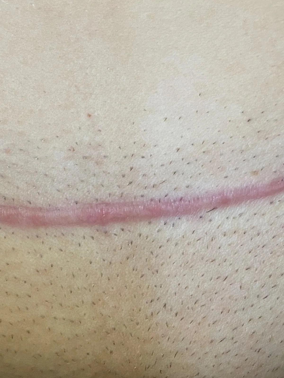 Blizna w okolicy pachwiny przed leczeniem