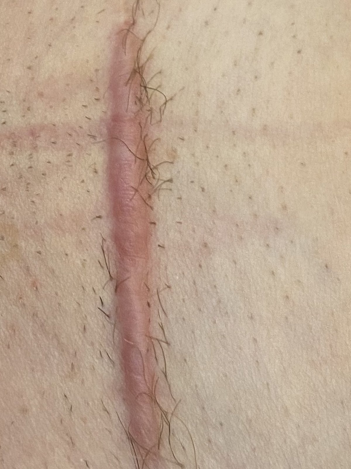 Blizna na plecach przed leczeniem