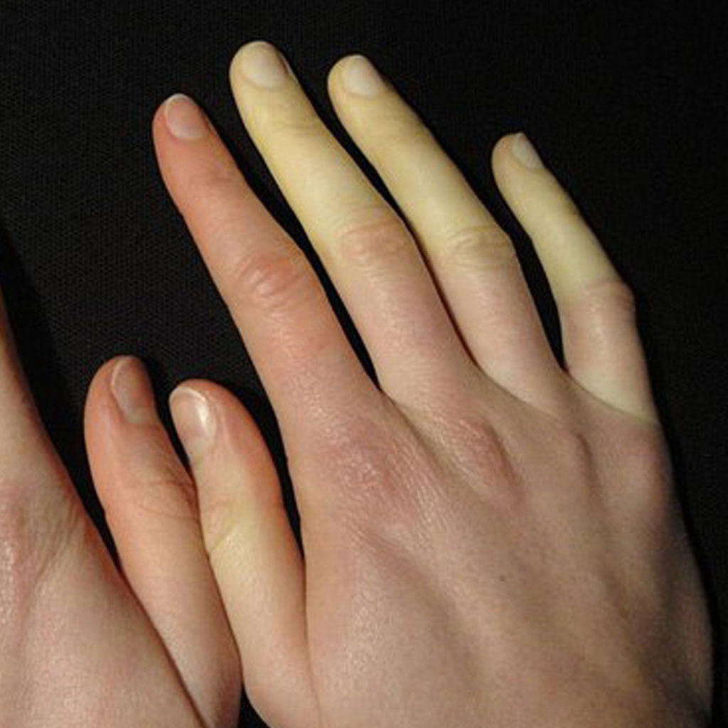 Jak wygląda objaw Raynauda