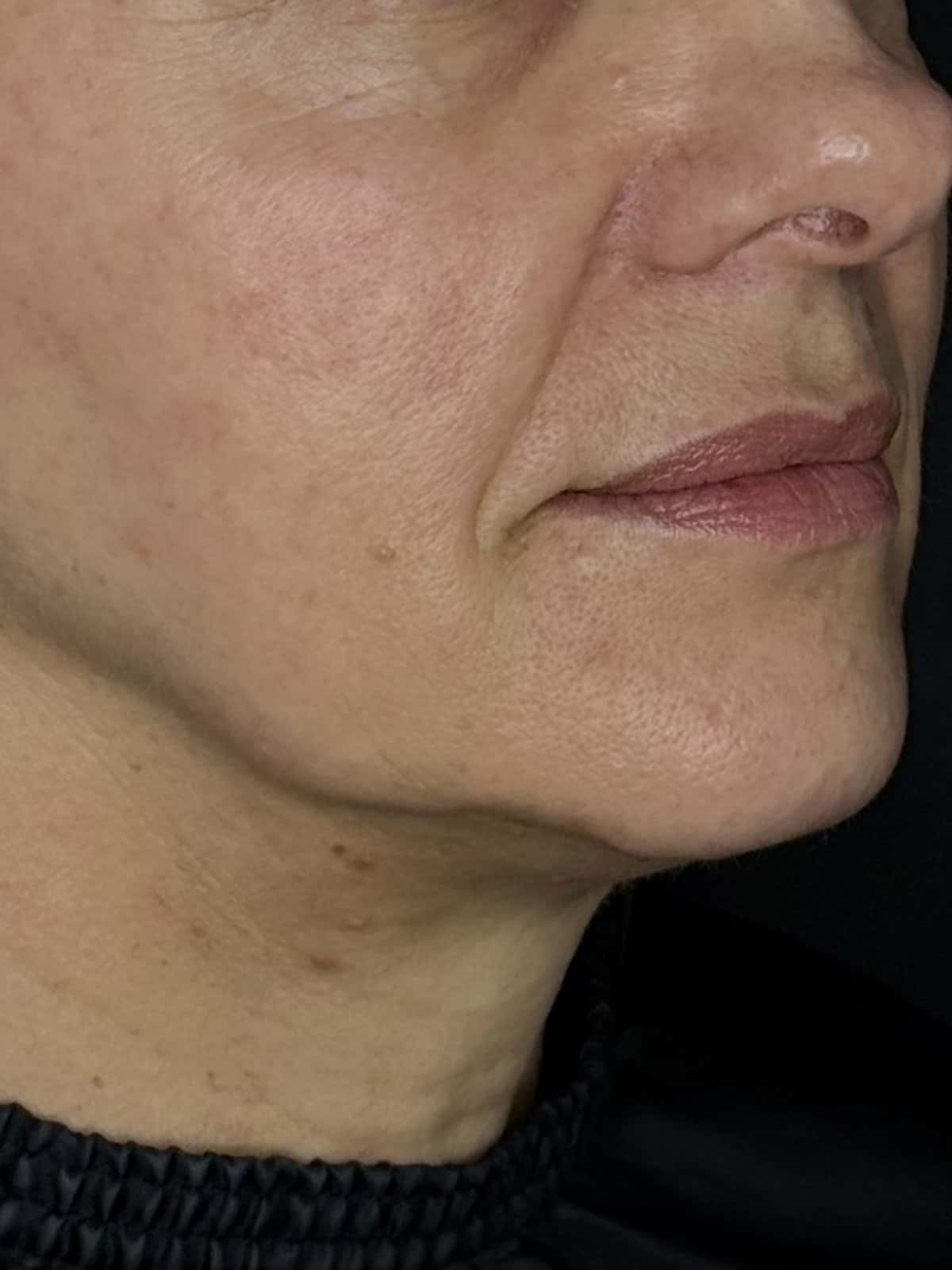 Twarz przed zabiegiem biostymulującym